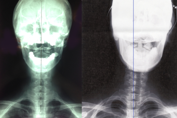 実際のレントゲンで比較して確認してみましょう。正常な首の骨の状態と異常な首の骨の状態です