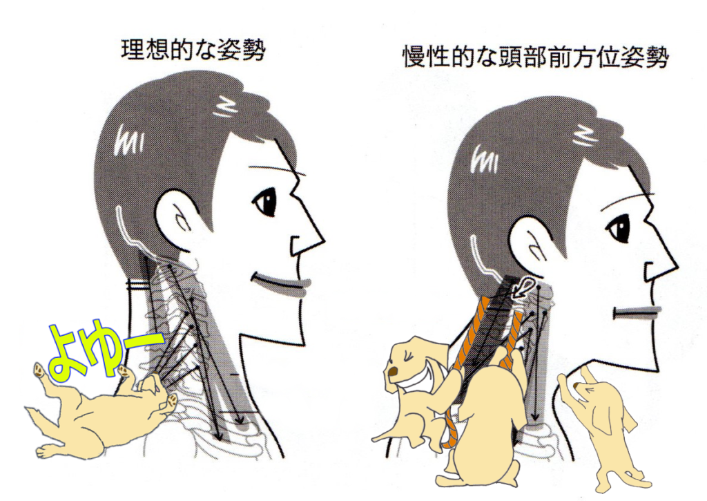 筋肉で頭を支えなくていけない構造のために頭痛・偏頭痛が発生 width=
